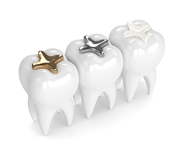3D rendering of three teeth each with a different dental filling material: composite, amalgam, and gold