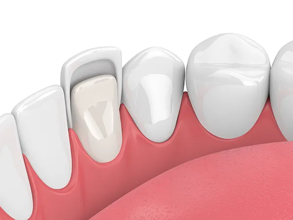 Close up 3D rendering of a thin porcelain veneer being applied to a tooth