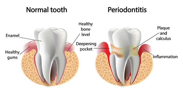 Side by side drawings comparing a healthy tooth with another tooth suffering from periodontal disease
