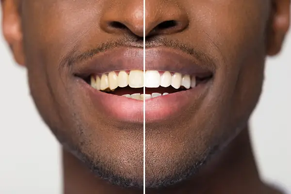 Close up comparison of before and after teeth whitening treatment on a Black man's smile